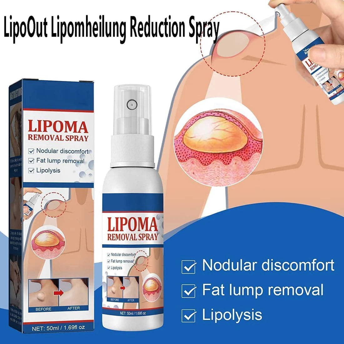 LAST DAY OF DISCOUNT 🔥 LIPOMA REMOVAL SPRAY